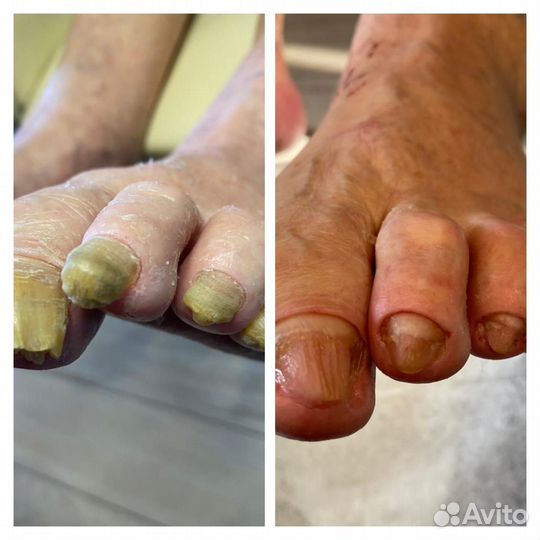 Лечение ногтей на ногах, подолог