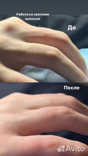 Электроэпиляция