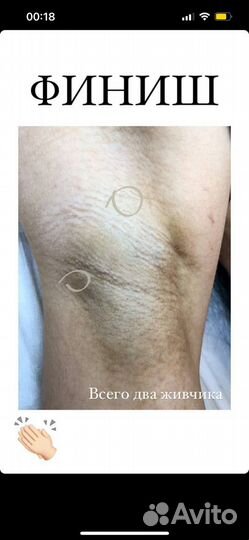 Электроэпиляция классическое бикини