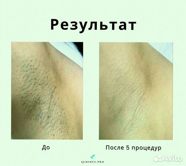 Диодный лазер люминес Макс’Ван 1200