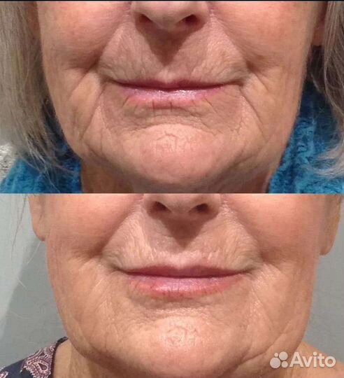 Биоревитализация