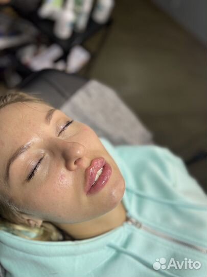 Аугментация губ