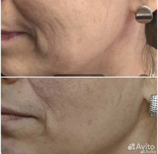 Безоперационная блефаропластика