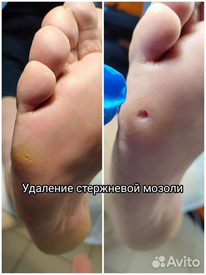 Подолог с выездом на дом