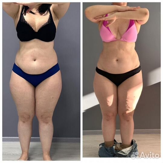 Антицеллюлитный массаж аппаратная коррекция LPG