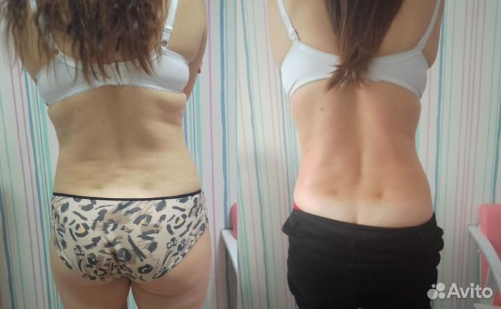 Массаж антицеллюлитный