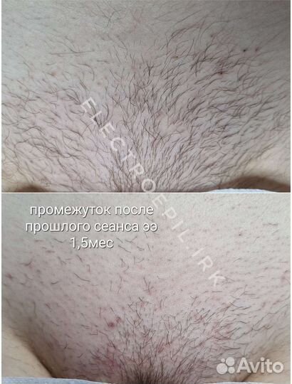 Электроэпиляция: глубокое бикини