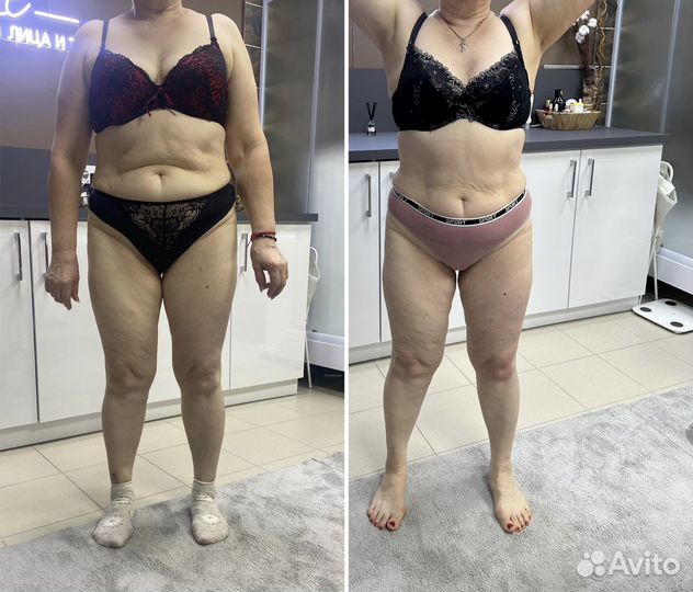 LPG массаж, RF, вакуумно роликовый массаж