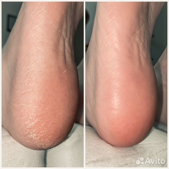 Педикюр Golden Trace