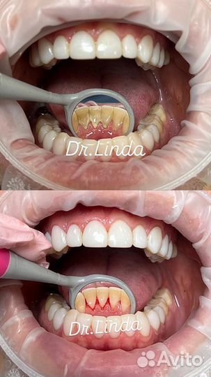 Чистка зубов