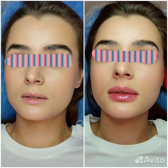 Биоревитализация