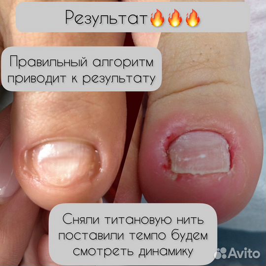 Лечебный педикюр