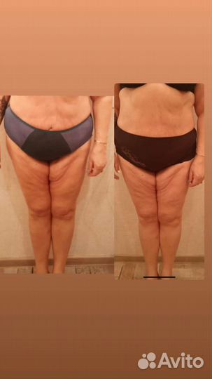 Lpg массаж по маслу