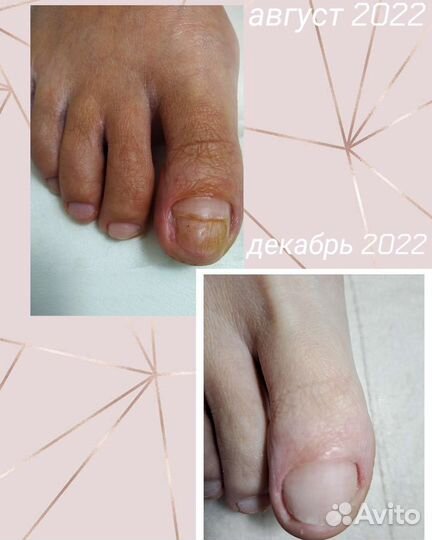 Педикюр, подолог, выезд на дом