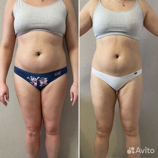 LPG массаж B-flexy