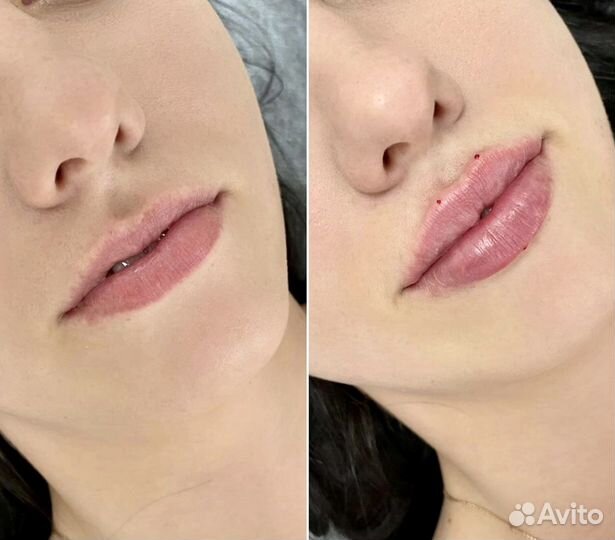 Биоревитализация