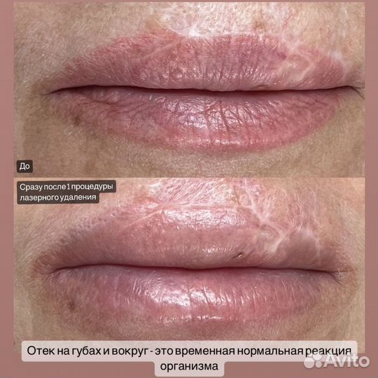 Удаление татуажа/тату ремувером/лазером, Перманент