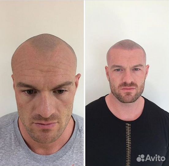 Трихопигментация алопеция головы камуфляж залысин