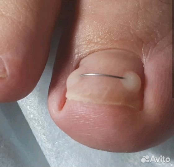 Подолог юмр, педикюр, маникюр, вросший ноготь кс