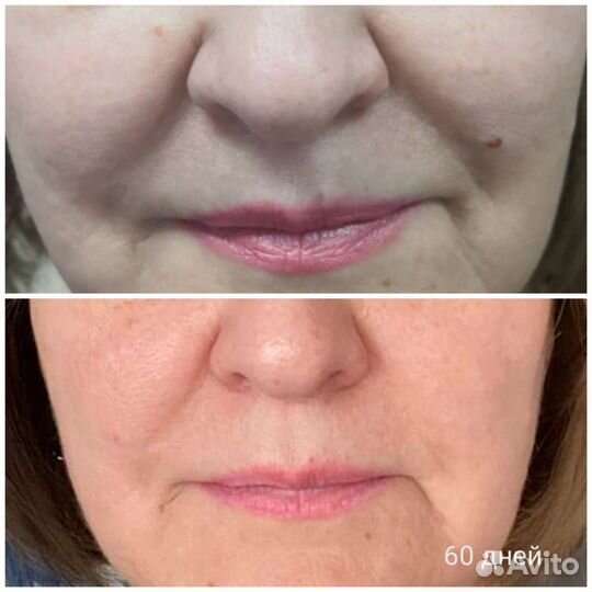 Блефаропластика без операции, нависшее веко, мешки