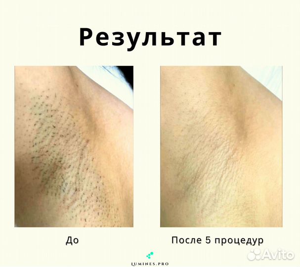 Диодный лазер для эпиляции «Lumines» Макс’Ван 1200 Вт