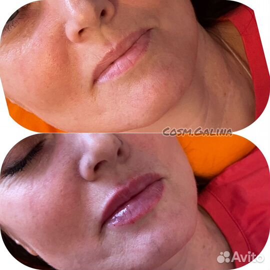 Увеличение губ, ботокс