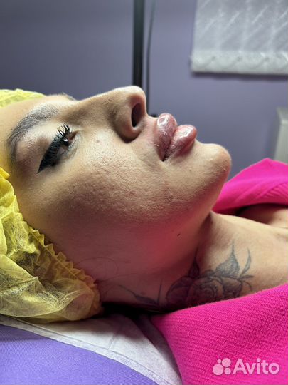 Увеличение Губ