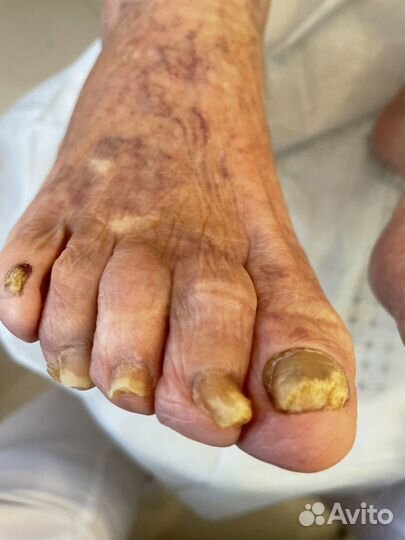 Педикюр Подология Бесплатно консультация