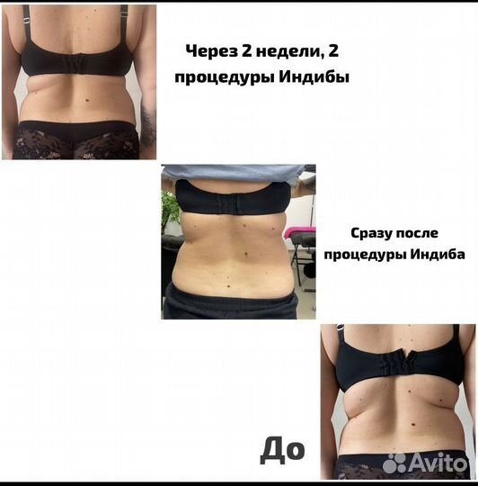 Аппаратный массаж, коррекция тела