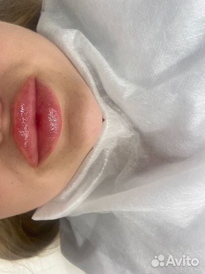 Контурная пластика губ