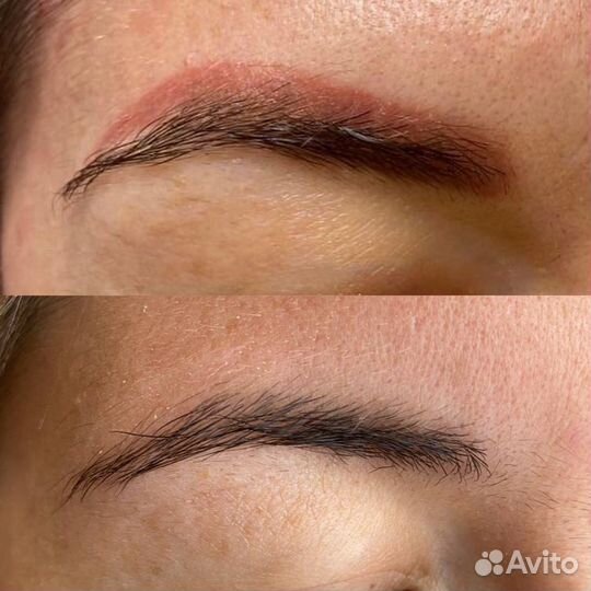 Удаление татуажа и тату