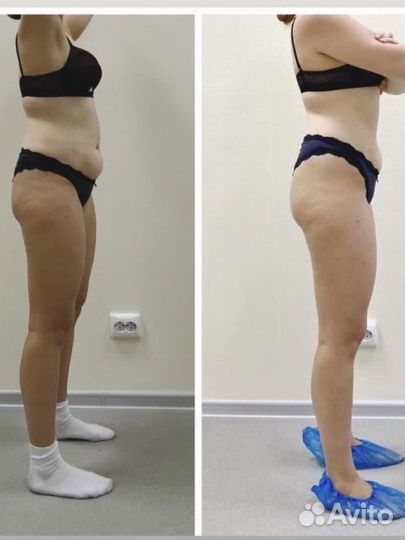 Вакуумно-роликовый массаж тела