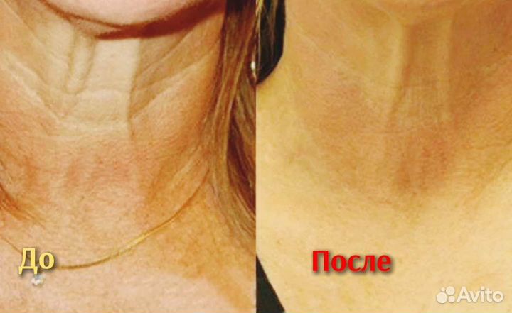 Шея, подтяжка