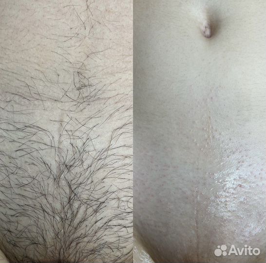 Шугаринг: подмышки