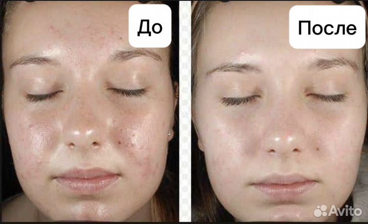 Косметолог Чистка лица Пилинг