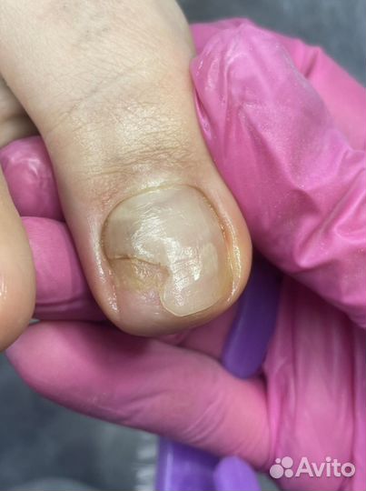 Педикюр лечебный - подолог