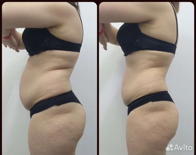 Массаж Тела(Коррекция Фигуры) Лечим Спину(Горбы)