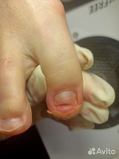 Лечебный педикюр