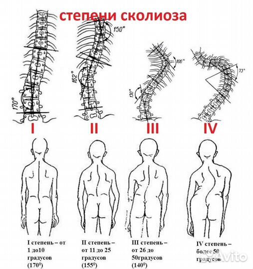 Скалиоз, массаж при скалиозе