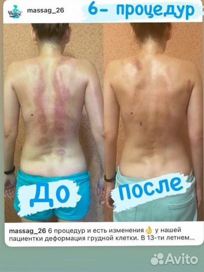 Лечебный массаж