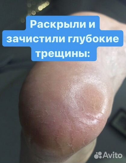 Подолог, вросший ногототь, зачистка грибка, трещин