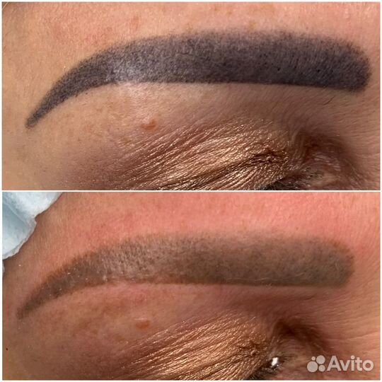 Лазер для удаления татуажа