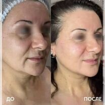 Биоревитализация, колагеностимуляция, Владимир