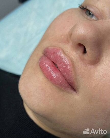 TCA-пилинг лица