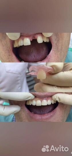 Ремонт, чистка зубных протезов