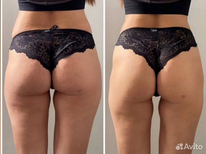 Аппаратный массаж / коррекция фигуры