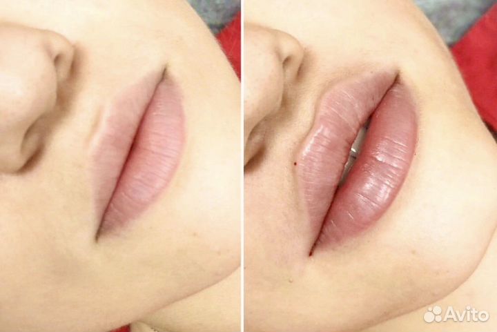 Биоревитализация