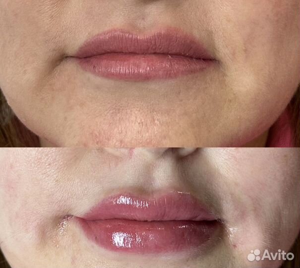 Косметолог, увеличение губ