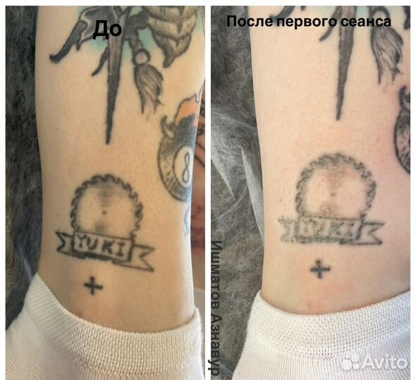 Лазерное удаление тату
