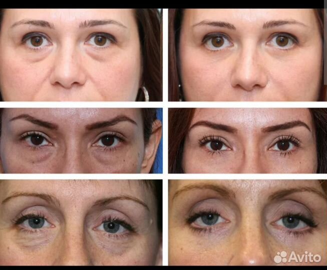 Массажер Франция для области вокруг глаз Gezatone